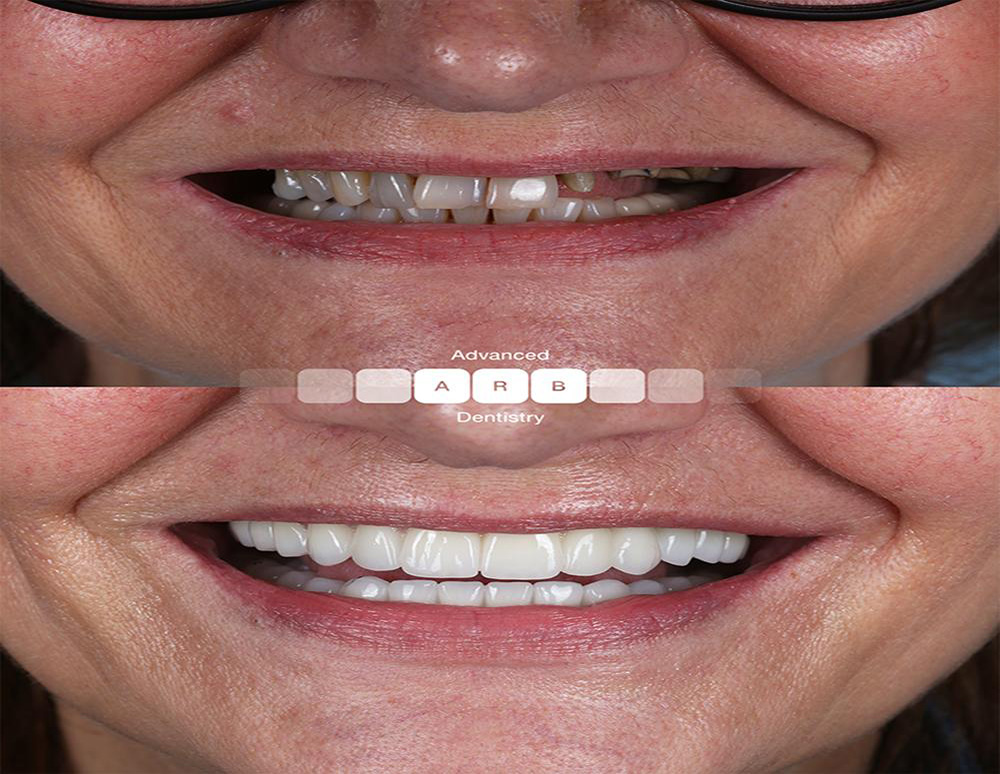 https://smileviadentaltourism-ks.com/wp-content/uploads/2025/06/before_after_2.jpg